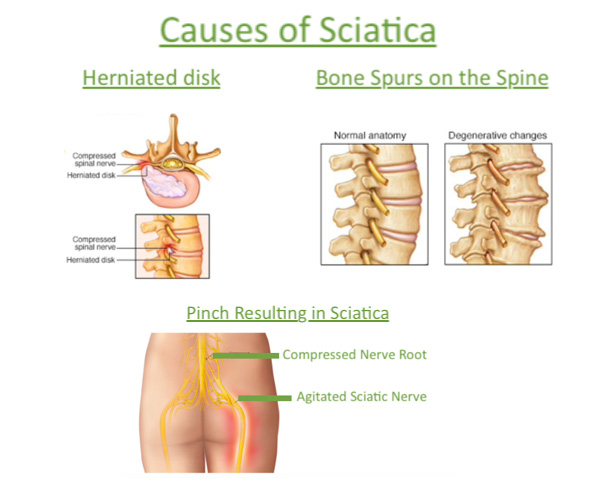 What causes sciatica and which treatments can stop the pain .